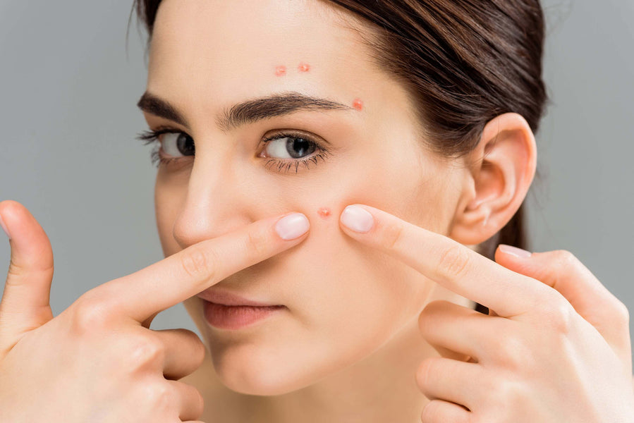 Desbloqueie a pele clara: o melhor tratamento hormonal para acne