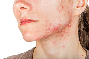 How to Get Rid of Cystic Acne: Effective Treatment Tips
