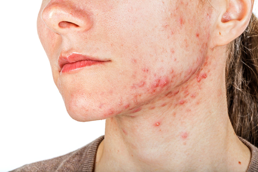 Hoe zich te ontdoen van cystische acne: effectieve behandelingstips