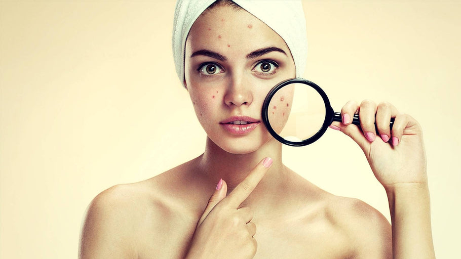 Beneficios Pueraria Mirifica Acne: Cómo ayuda con la piel aceitosa y los blancos