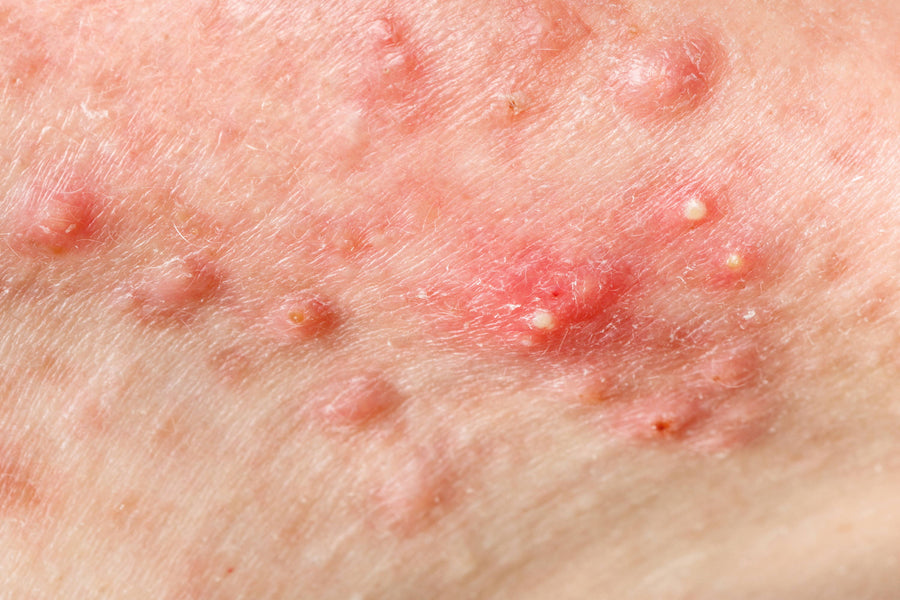 Behandlung von knotiger Akne: Das Selbstvertrauen der Haut zurückgewinnen