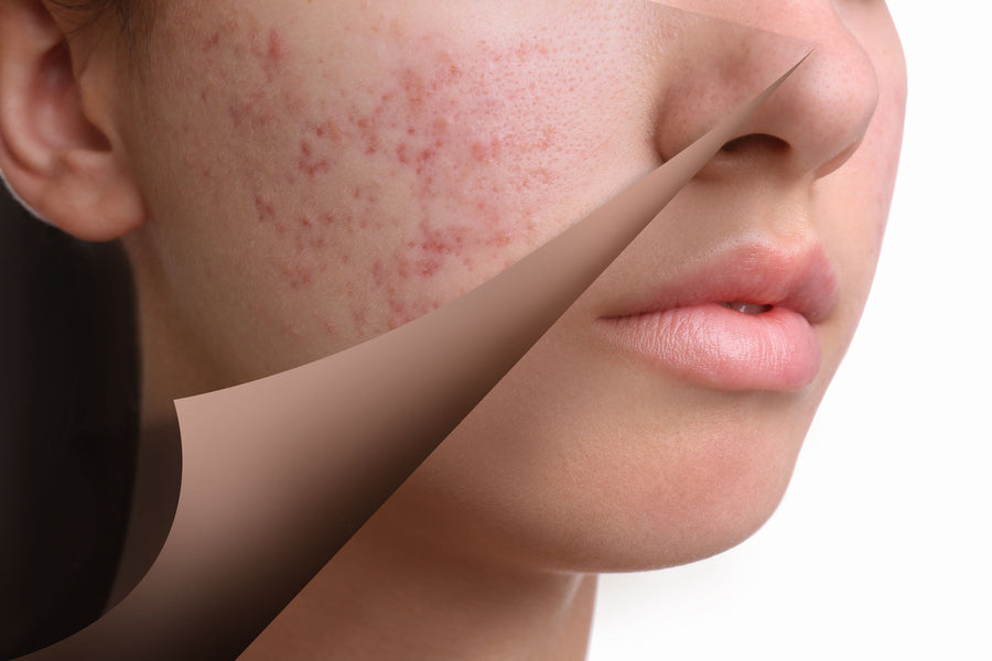 Achieve Radiant Beauty: Here's How to Get Clear Skin Fast