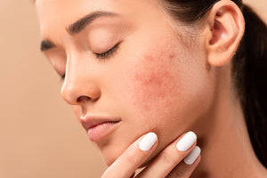 Skin Reset: Learn How to Get Rid of Blemishes on Face