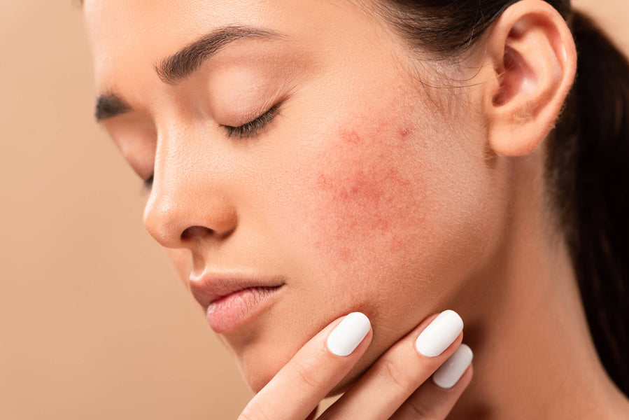 Réinitialisation de la peau : apprenez à vous débarrasser des imperfections du visage