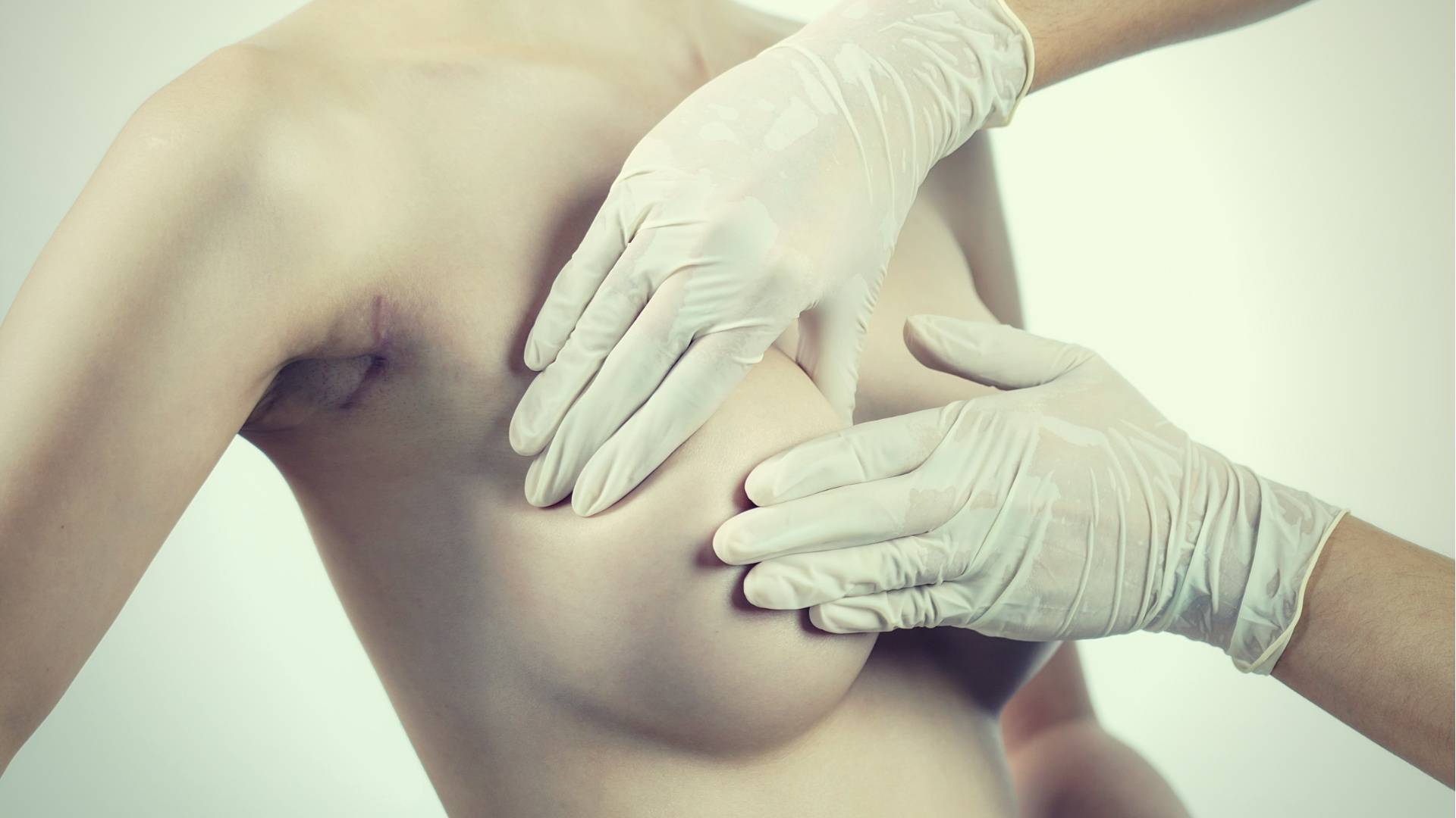 Implantation des seins Suppression : Principales choses Vous devez savoir avant d'entrer en chirurgie