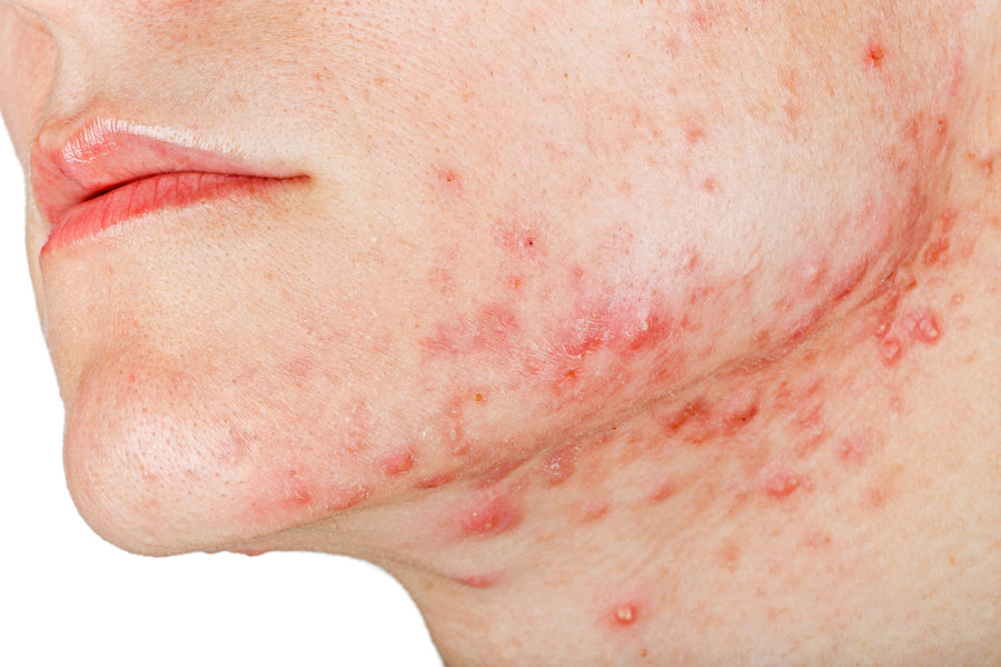 Soluções calmantes: como se livrar da acne inflamatória