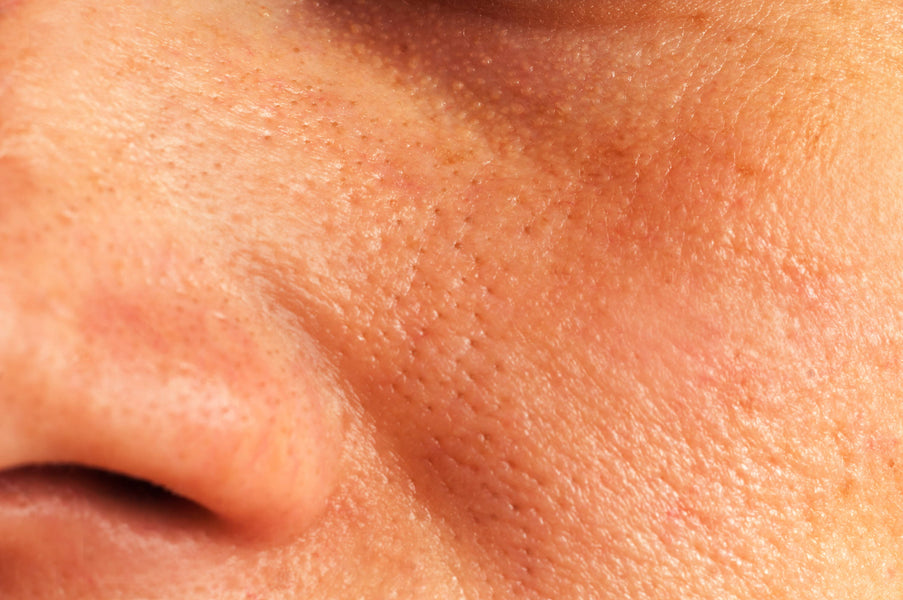 Évasion des pores dilatés : maîtriser l'éclat sans pores